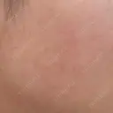 ルメッカ ルラ美容クリニック 福岡本院 AFTER サムネイル用