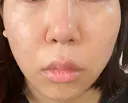 ハイフ（顔） 表参道美容外科クリニック DAY 1 サムネイル用
