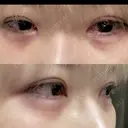 ヒアルロン酸注入（涙袋） ファイヤークリニック 渋谷院 DAY 0 サムネイル用
