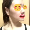 ボトックス（あご） / ボトックス（エラ・小顔） / ボトックス（肩） / ハイフ（顔） TCB東京中央美容外科 船橋院 DAY 2 サムネイル用