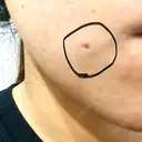 ほくろ・いぼ切除（肌） R Beauty CLINIC 名古屋院 DAY 10 サムネイル用
