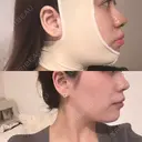 その他（鼻） / バッカルファット除去 / 鼻尖形成（非切開） / 小鼻縮小（非切開） / ボトックス（エラ・小顔） / ヒアルロン酸注入（唇） / ボトックス（肩） TCB東京中央美容外科 広島院 AFTER サムネイル用