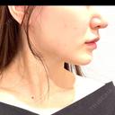 糸リフト / 脂肪吸引（顔） / ジョールファット除去 / ボトックス（エラ・小顔） R Beauty CLINIC 名古屋院 DAY 30 サムネイル用