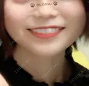 骨削り（頬） 湘南美容クリニック 新橋銀座口院 DAY 13 サムネイル用