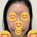 光治療（フォトフェイシャルなど） DMTC美容皮膚科 大宮院 DAY 21 サムネイル用