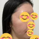 光治療（フォトフェイシャルなど） DMTC美容皮膚科 大宮院 DAY 21 サムネイル用