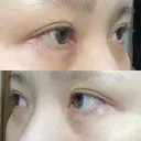 ヒアルロン酸注入（涙袋） ファイヤークリニック 渋谷院 DAY 3 サムネイル用