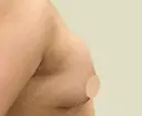 その他（胸） WOM CLINIC GINZA （ワム クリニック ギンザ） AFTER サムネイル用