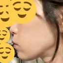 ボトックス（あご） / ヒアルロン酸注入（あご） / ヒアルロン酸注入（唇） KAGA CLINIC DAY 0 サムネイル用
