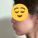 ボトックス（あご） / ヒアルロン酸注入（あご） / ヒアルロン酸注入（唇） KAGA CLINIC DAY 16 サムネイル用