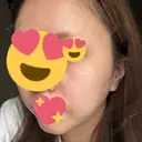 ピコレーザートーニング（美白・肝斑） / レーザートーニング（美白・肝斑） ルラ美容クリニック 渋谷本院 DAY 3 サムネイル用