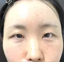 クマ治療 / こめかみ形成 / 脂肪注入（額） / 脂肪注入（目の下） / ボトックス（額） X CLINIC 銀座院 AFTER サムネイル用