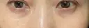 下まぶたの脂肪取り / 脂肪注入（肌） / 脂肪注入（目の下） X CLINIC 大阪院 AFTER サムネイル用