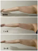 脂肪吸引（二の腕） / 脂肪吸引（肩） Mods Clinic（モッズクリニック） 大阪院 DAY 91 サムネイル用
