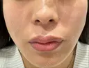 ボトックス（エラ・小顔） / ヒアルロン酸注入（鼻翼基部） R Beauty CLINIC 名古屋院 AFTER サムネイル用