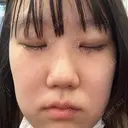 二重埋没 / 目頭切開 Olino美容外科・美容皮膚科 DAY 7 サムネイル用