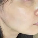 その他（肌） / ポテンツァ オラクル美容皮膚科 大阪梅田院 DAY 0 サムネイル用