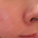 ピーリング（ハリ・ツヤ） Re:anne clinic 銀座 【リアンクリニック銀座】 AFTER サムネイル用