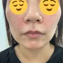 ヒアルロン酸注入（頬） 渋谷美容外科クリニック 渋谷院 DAY 0 サムネイル用