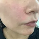 ヒアルロン酸注入（頬） 渋谷美容外科クリニック 渋谷院 DAY 0 サムネイル用