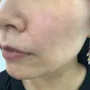 ヒアルロン酸注入（頬） 渋谷美容外科クリニック 渋谷院 DAY 0 サムネイル用