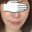 ヒアルロン酸注入（頬） サフォクリニック AFTER サムネイル用