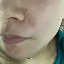 ヒアルロン酸注入（頬） 渋谷美容外科クリニック 渋谷院 DAY 1 サムネイル用