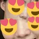 鼻中隔延長（切開） / 鼻尖縮小 ビスポーククリニック 福岡院 AFTER サムネイル用