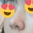 鼻中隔延長（切開） / 鼻尖縮小 ビスポーククリニック 福岡院 DAY 601 サムネイル用