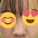 鼻中隔延長（切開） / 鼻尖縮小 ビスポーククリニック 福岡院 DAY 601 サムネイル用