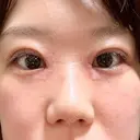 二重埋没 / 目頭切開 Olino美容外科・美容皮膚科 DAY 8 サムネイル用