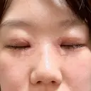 二重埋没 / 目頭切開 Olino美容外科・美容皮膚科 DAY 8 サムネイル用