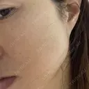 光治療（フォトフェイシャルなど） / ピーリング（ハリ・ツヤ） ミニマムスキンクリニック銀座 DAY 1 サムネイル用