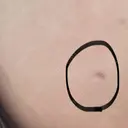 ほくろ・いぼ切除（肌） R Beauty CLINIC 名古屋院 AFTER サムネイル用