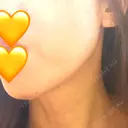 糸リフト アリエル美容クリニック 郡山院 DAY 39 サムネイル用