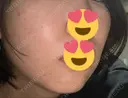 ハイフ（顔） 表参道美容外科クリニック DAY 3 サムネイル用