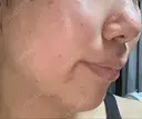 ハイフ（顔） 表参道美容外科クリニック AFTER サムネイル用