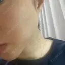 光治療（フォトフェイシャルなど） / ピーリング（ハリ・ツヤ） ミニマムスキンクリニック銀座 DAY 2 サムネイル用
