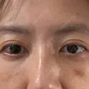下まぶたの脂肪取り APOLLO BEAUTY CLINIC DAY 11 サムネイル用