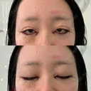 目頭切開 / クマ治療 / 目尻切開 / 下まぶたの脂肪取り / タレ目形成・グラマラスライン（切開） / タレ目形成・グラマラスライン（埋没） / ヒアルロン酸注入（涙袋） / ボトックス（エラ・小顔） Tokyo Tensei Clinic 銀座院 DAY 0 サムネイル用
