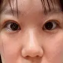 二重埋没 / 目頭切開 Olino美容外科・美容皮膚科 DAY 9 サムネイル用