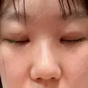二重埋没 / 目頭切開 Olino美容外科・美容皮膚科 DAY 9 サムネイル用
