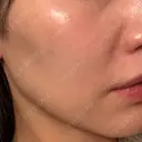 エレクトロポレーション / 毛穴洗浄（ハイドラフェイシャルなど） Re：HADA CLINIC 銀座 AFTER サムネイル用