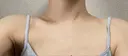 ボトックス（肩） / ボトックス（二の腕） DMTC美容皮膚科 大宮院 AFTER サムネイル用