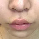 人中短縮 / ボトックス（人中） eクリニック 金沢本院 DAY 3 サムネイル用