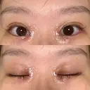 二重埋没 / 目頭切開 Olino美容外科・美容皮膚科 DAY 10 サムネイル用