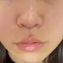 人中短縮 / ボトックス（人中） eクリニック 金沢本院 DAY 3 サムネイル用