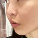 人中短縮 / ボトックス（人中） eクリニック 金沢本院 DAY 3 サムネイル用