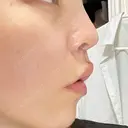 人中短縮 / ボトックス（人中） eクリニック 金沢本院 DAY 3 サムネイル用