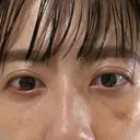 下まぶたの脂肪取り APOLLO BEAUTY CLINIC DAY 12 サムネイル用